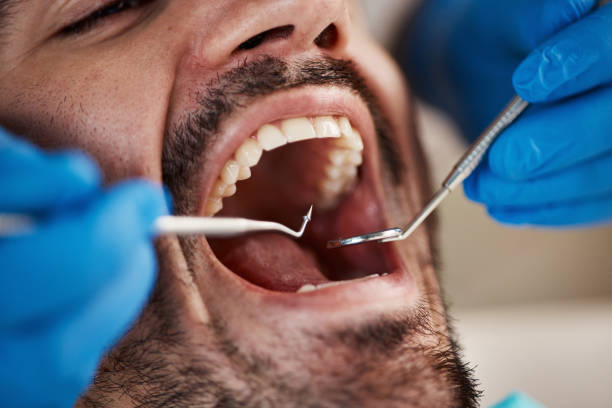Best Emergency Treatment for Dental Infections or Abscesses in Shingle Springs, CA